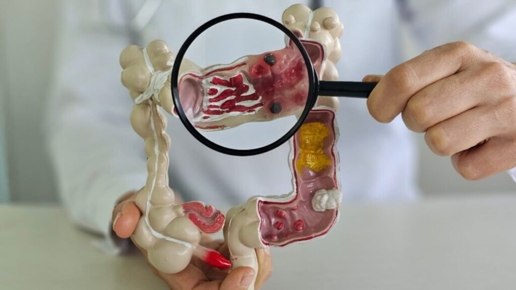 Oncologist warns colon cancer diagnoses rising among young adults; shares risk factors, symptoms, screening, prevention | Health