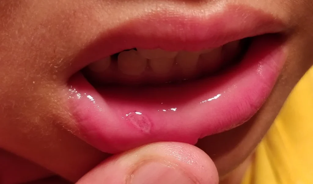 troubled by mouth ulcers then try these home remedies see effect soon