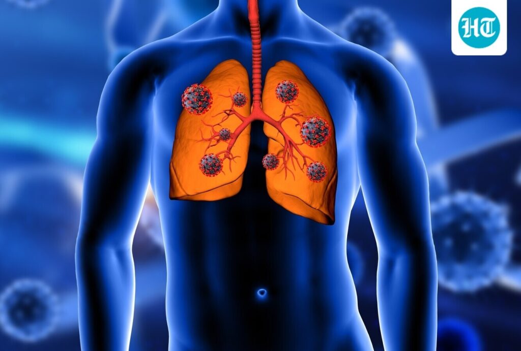 Pulmonologist reveals if you can get lung cancer even when you have never smoked in your life: ‘20% cases happen in…’