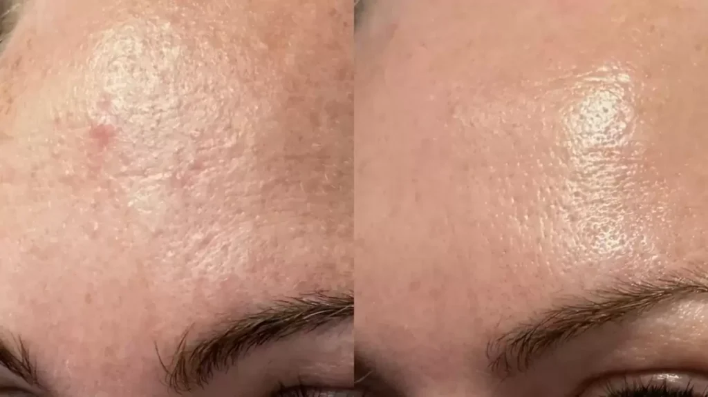 Woman uses ChatGPT to create ‘custom skin care routine’, shares impressive before and after pics