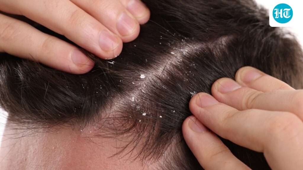 Dandruff is not just about poor hygiene: Dermatologist explains its link with scalp infections, diet, and overall health