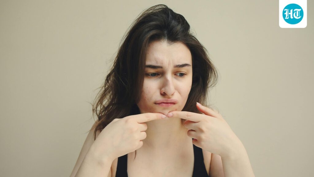 Dermatologist says there is a clear link between teenage acne and depression; warns ‘The signs need attention’