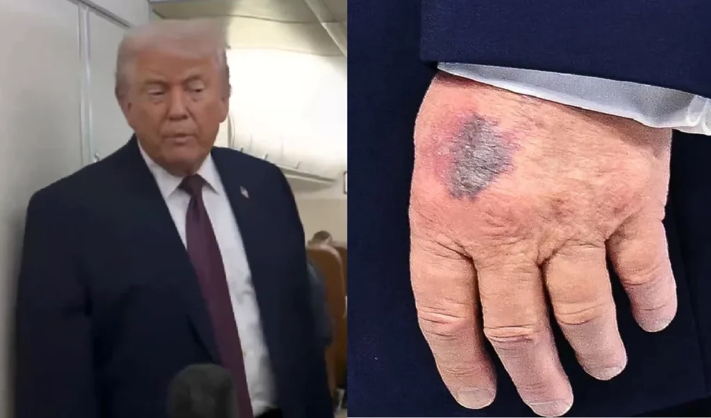 क्या बिगड़ रही है सुपरपावर देश के राष्ट्रपति की हालत, ट्रंप के हाथ पर ये जख्म कैसा? क्या बिगड़ रही है सुपरपावर देश के राष्ट्रपति की हालत, ट्रंप के हाथ पर ये जख्म कैसा?
