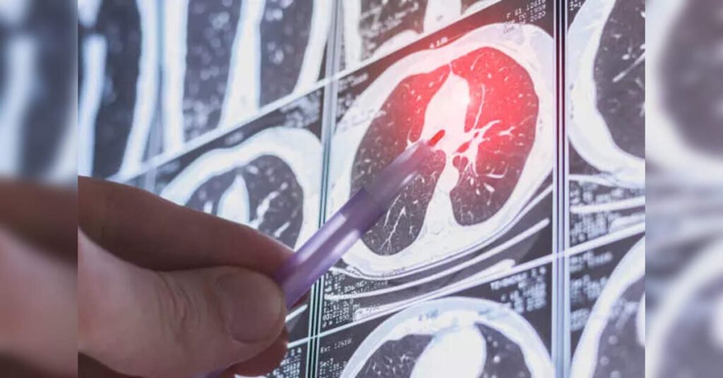 Revolutionary AI Device Developed by Kamala Nehru Hospital and IIT-K for Lung Cancer Detection, ETHealthworld
