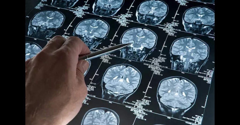 New Study Reveals How Brain Tumours Manipulate Sugar Metabolism to Fuel Growth, ETHealthworld