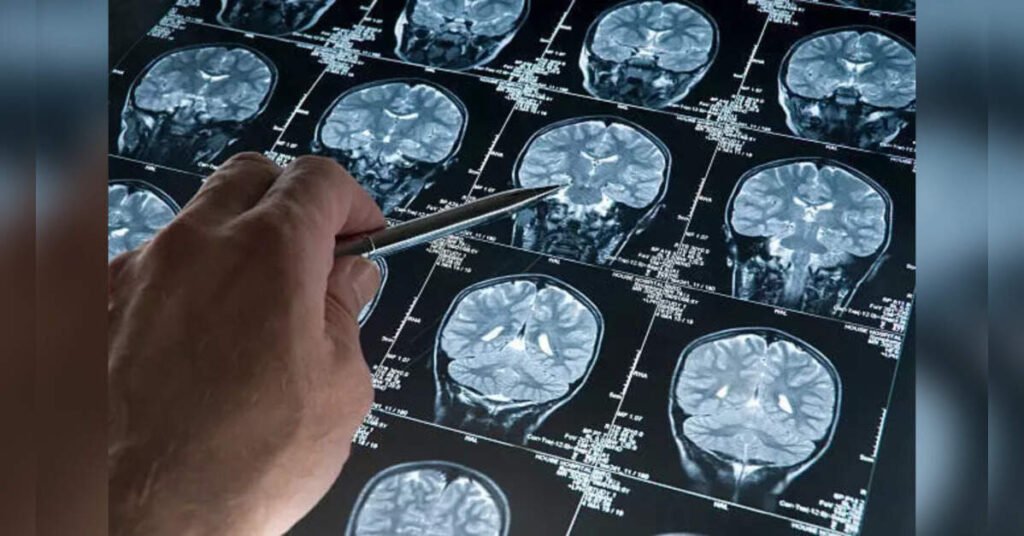 Study Links Parkinson’s Protein to Accelerated Alzheimer’s in Women, ETHealthworld