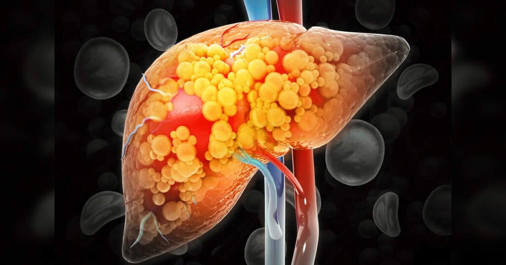 One in Three Urban Indians at Risk of Fatty Liver Disease; Health Experts Warn of Growing Concern, ETHealthworld