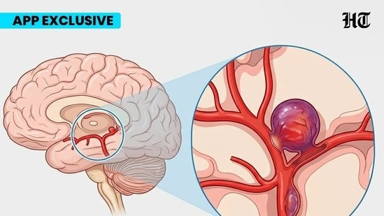 What is a brain aneurysm? Neurosurgeon with 26 years of experience explains why it is a life-threatening emergency What is a brain aneurysm? Neurosurgeon with 26 years of experience explains why it is a life-threatening emergency