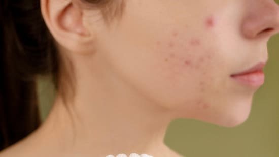 Ice creams to fried treats: Dermatologist shares common summer foods that may quietly trigger acne problems Ice creams to fried treats: Dermatologist shares common summer foods that may quietly trigger acne problems