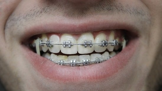 Are dental braces only for teenagers? Orthodontist debunks myths about the medical device Are dental braces only for teenagers? Orthodontist debunks myths about the medical device