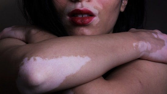 Can vitiligo spread? Dermatologist explain what really causes new white patches to appear Can vitiligo spread? Dermatologist explain what really causes new white patches to appear
