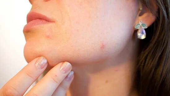 Is your acne telling a deeper story? Experts explain the link between blood sugar spikes, hormonal health and skin Is your acne telling a deeper story? Experts explain the link between blood sugar spikes, hormonal health and skin
