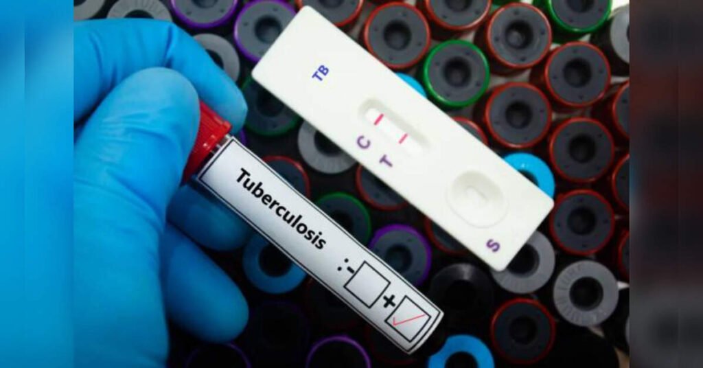 Revolutionary TB Death Risk Calculator Developed in India, Predicts Fatality at Diagnosis, ETHealthworld