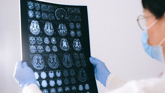 World Brain Tumour Day 2026: Doctors reveal 7 subtle brain tumour symptoms people often mistake for stress World Brain Tumour Day 2026: Doctors reveal 7 subtle brain tumour symptoms people often mistake for stress