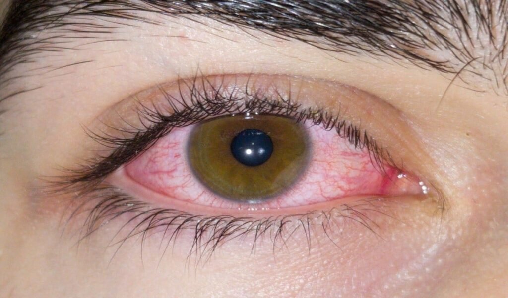 heatwave attack on eyes increasing redness and risk of infection learn eye care tips heatwave attack on eyes increasing redness and risk of infection learn eye care tips