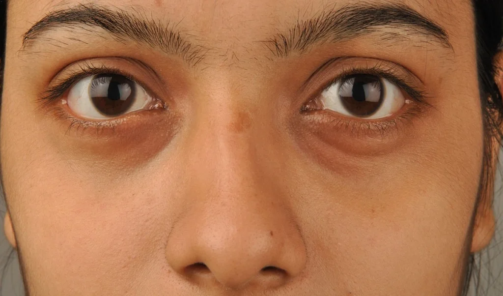Beauty Tips: थकी हुई आंखों को बनाएं Bright और Hydrated, साधारण क्रीम छोड़ अपनाएं Under Eye Patches का ये वायरल Skincare Trend Beauty Tips: थकी हुई आंखों को बनाएं Bright और Hydrated, साधारण क्रीम छोड़ अपनाएं Under Eye Patches का ये वायरल Skincare Trend