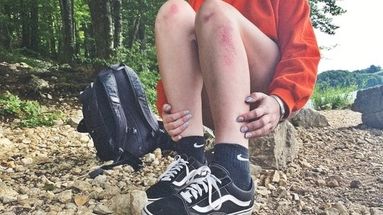Did you know some people get itchy when they exercise? Dr Kunal Sood explains why that happens Did you know some people get itchy when they exercise? Dr Kunal Sood explains why that happens