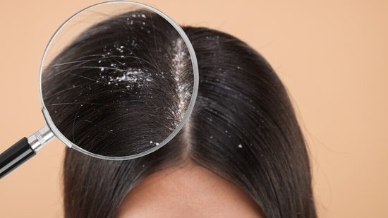 Itchy scalp, white flakes? Dermatologists Dr Sonali Kohli and Dr Gulrez Tyebkhan reveal why monsoon triggers dandruff Itchy scalp, white flakes? Dermatologists Dr Sonali Kohli and Dr Gulrez Tyebkhan reveal why monsoon triggers dandruff