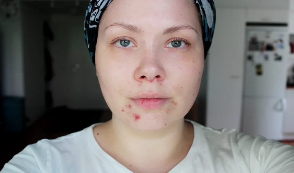 what monsoon acne connection learn this foolproof plan to achieve pimple free skin