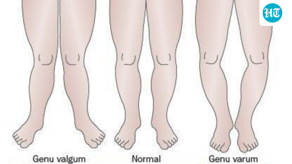 Bow legs vs knock knees: Paediatric orthopaedic Dr Somesh Virmani explains leg alignment in children, when to seek help Bow legs vs knock knees: Paediatric orthopaedic Dr Somesh Virmani explains leg alignment in children, when to seek help