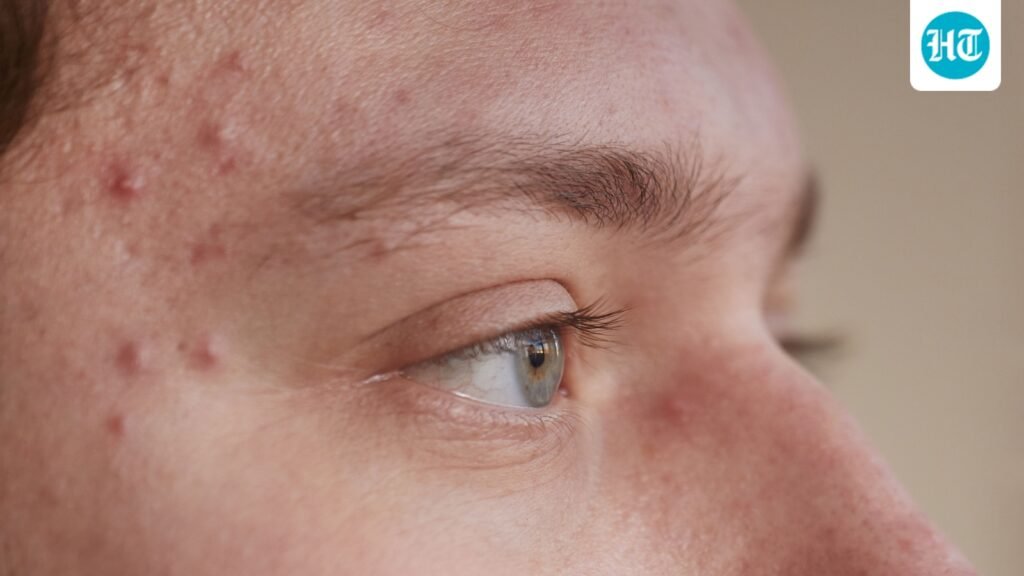 Experienced acne breakouts right before major events? Physician Dr Kunal Sood explains why that happens