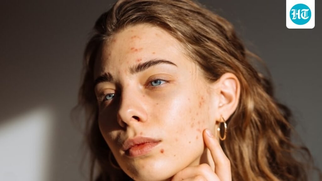 Fungal vs bacterial acne: Dermatologist explains how to identify your monsoon breakout Fungal vs bacterial acne: Dermatologist explains how to identify your monsoon breakout