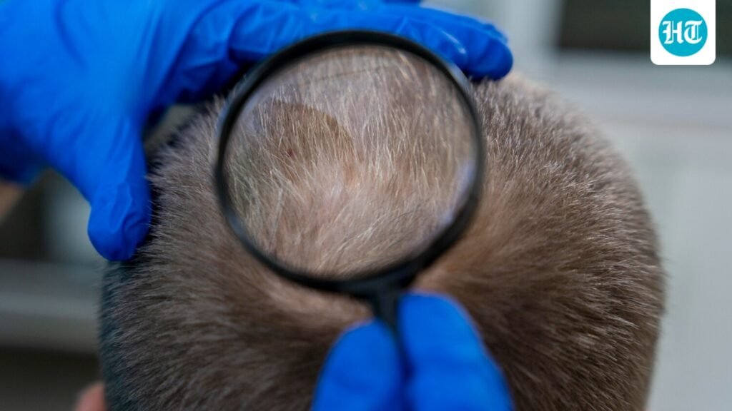 Noticed a sudden bald patch? Dermatologist identifies 8 possible reasons, from stress to fungal infection Noticed a sudden bald patch? Dermatologist identifies 8 possible reasons, from stress to fungal infection