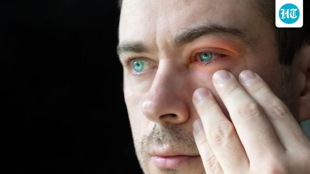 Red, watery eyes during monsoon? Ophthalmologist shares 5 common infections you should watch out for Red, watery eyes during monsoon? Ophthalmologist shares 5 common infections you should watch out for