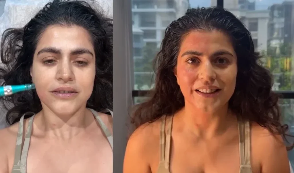 डरावने लुक के बाद मिलता है तुरंत ग्लो, Shenaz Treasury ने बताया Vampire Facial का सच डरावने लुक के बाद मिलता है तुरंत ग्लो, Shenaz Treasury ने बताया Vampire Facial का सच