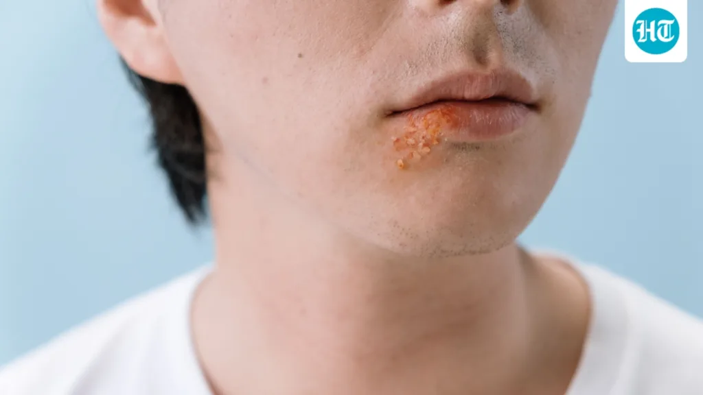 Think lip balm is ‘not for him’? Dermatologist shares 4 lip care tips every man should know