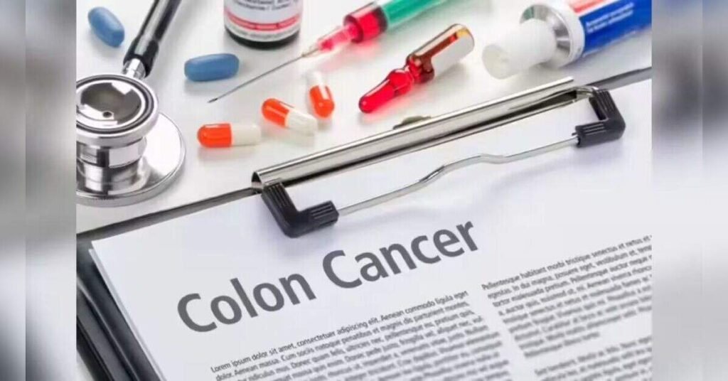Appendix removal linked with lower colon cancer risk in study, ETHealthworld
