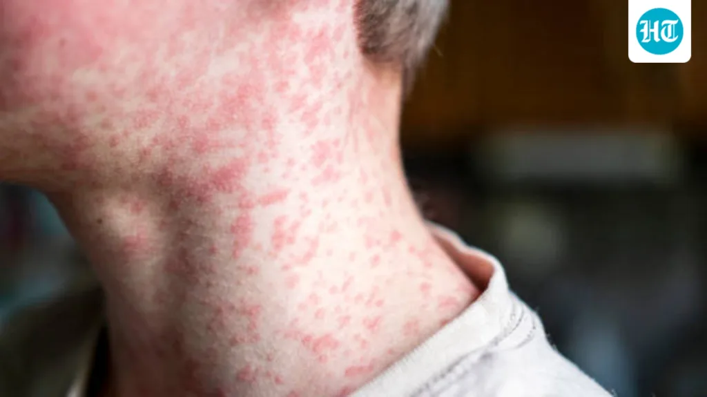 Skin rashes in children: Paediatrician explains common causes, warning signs and when parents should worry Skin rashes in children: Paediatrician explains common causes, warning signs and when parents should worry